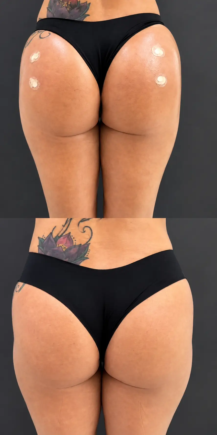 Before and after gluteal treatment, patient five