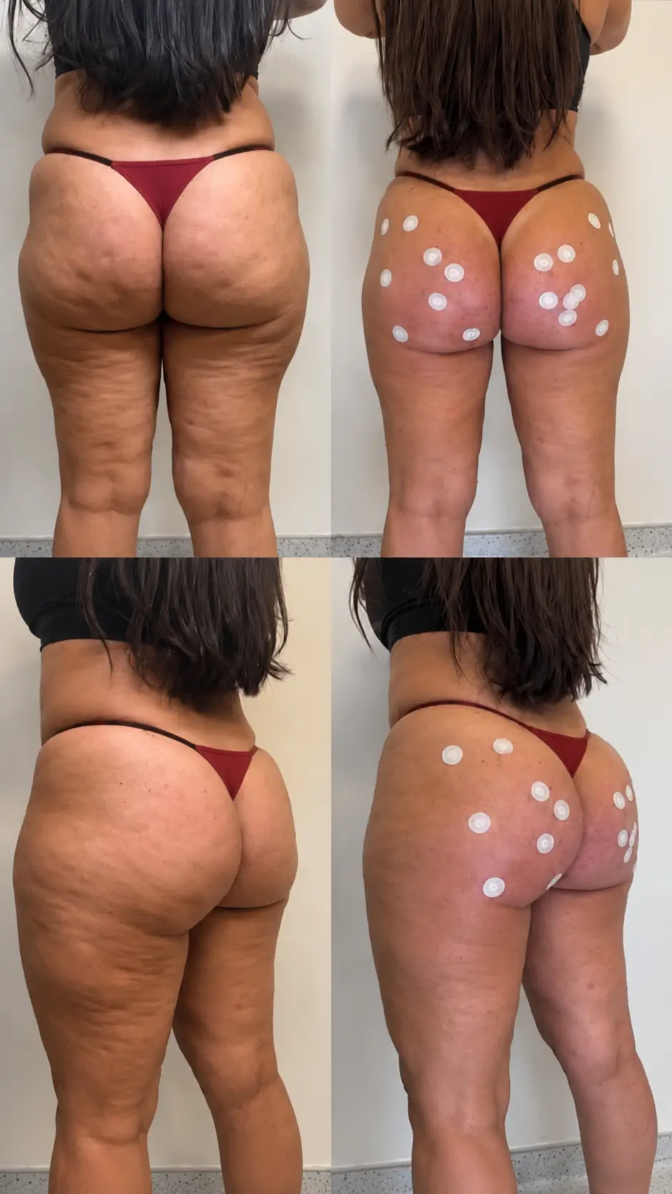 Before and after gluteal treatment, patient four