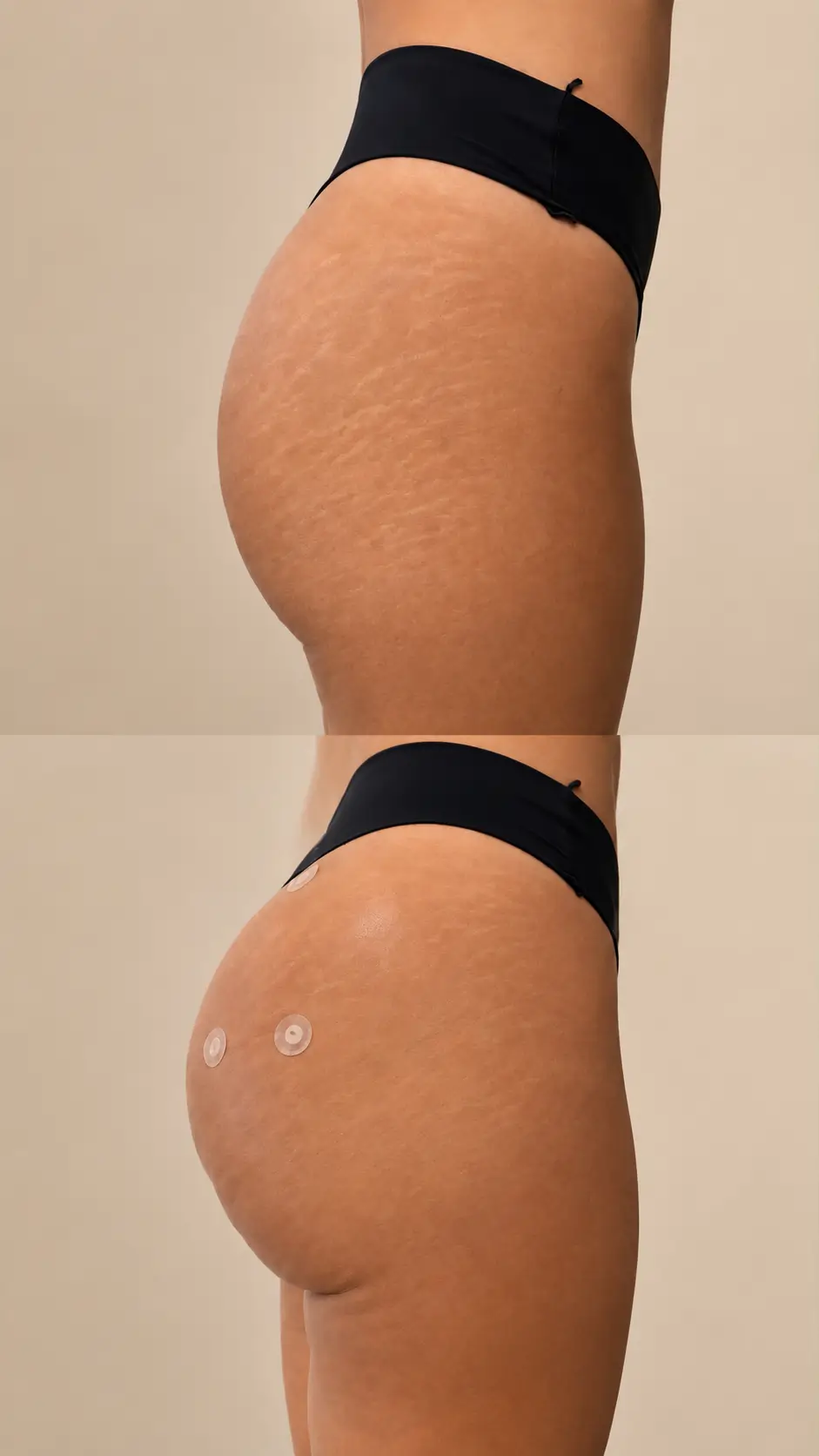 Before and after gluteal treatment, patient one