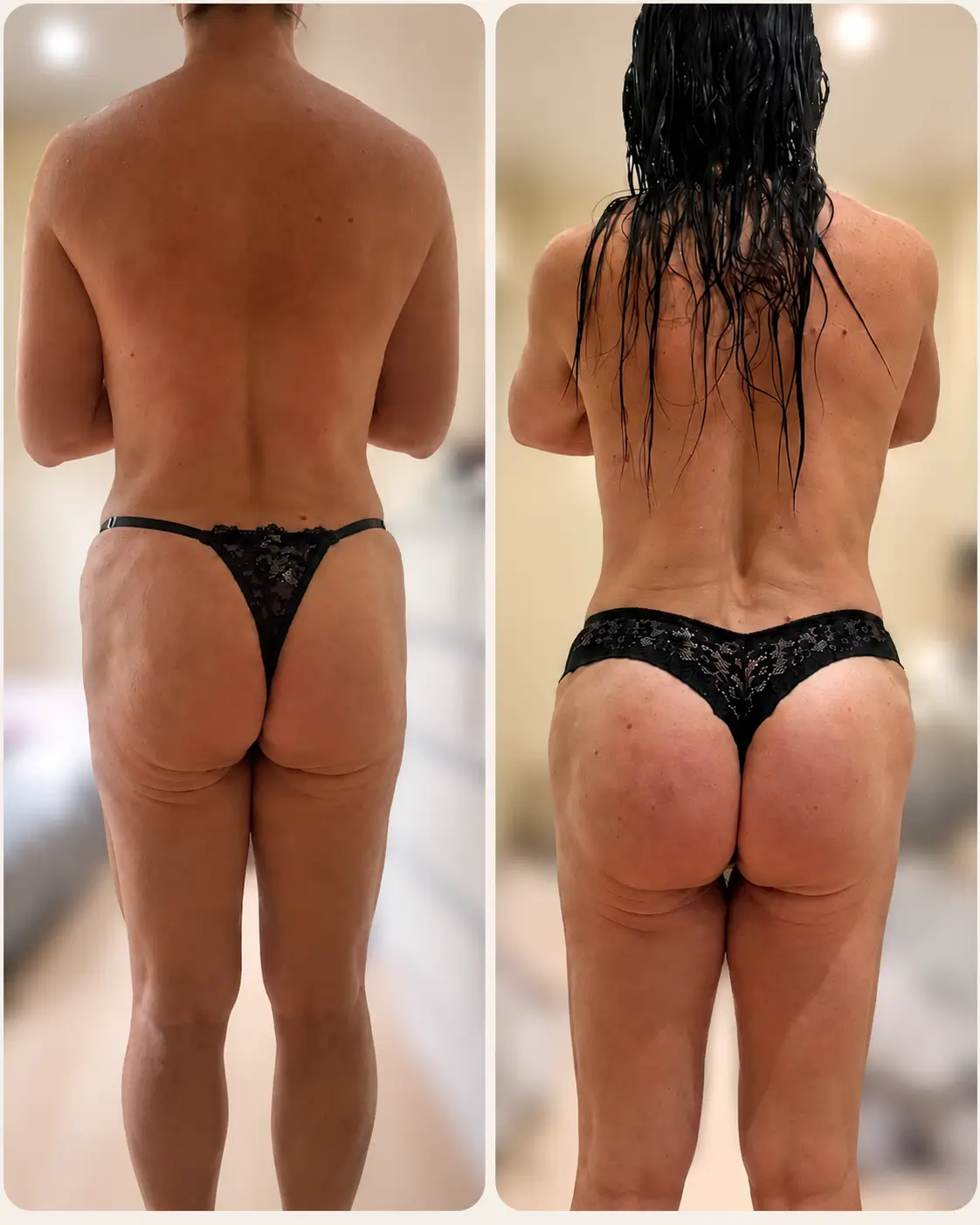 Before and after gluteal treatment, patient two